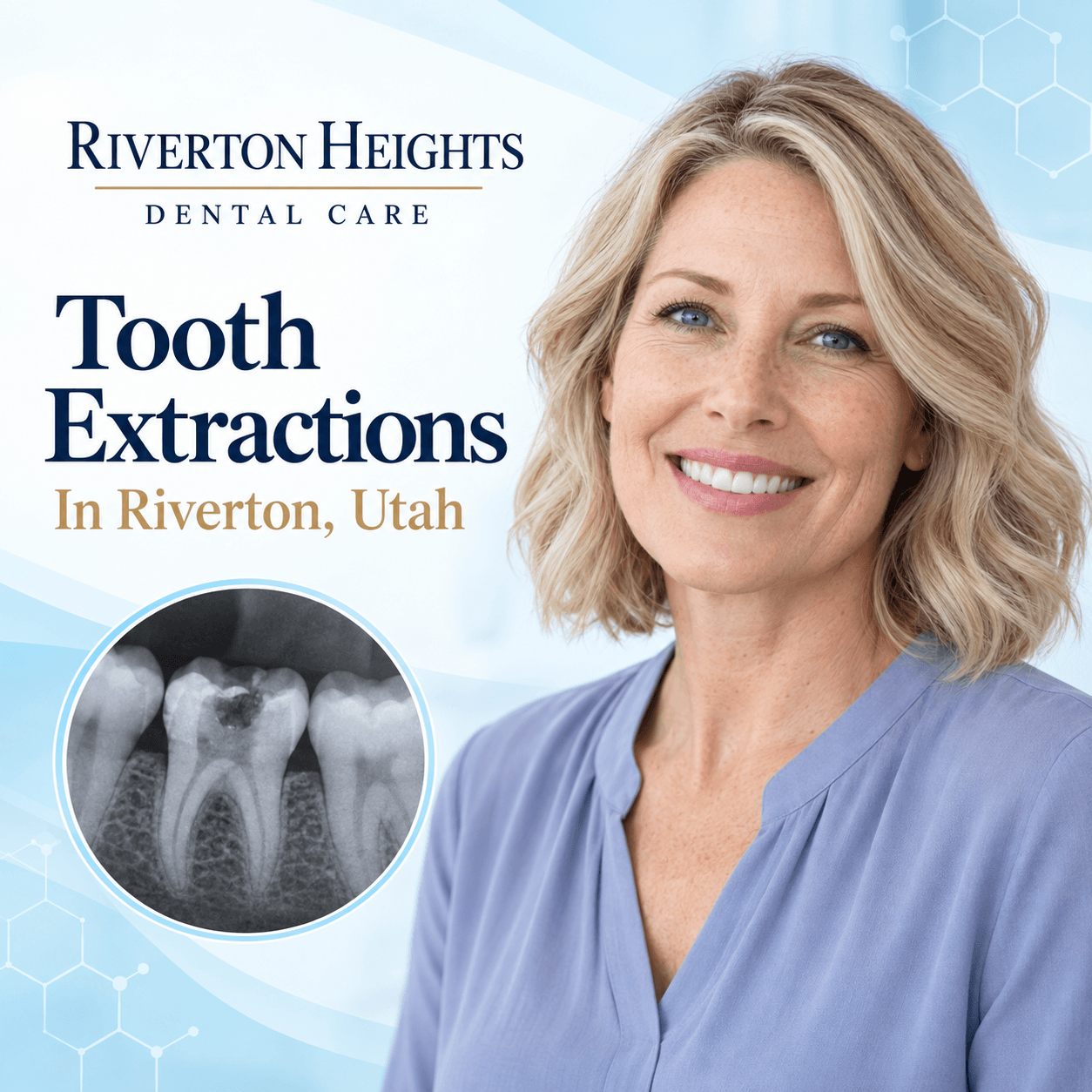 Expert Tooth Extractions In Riverton, Utah